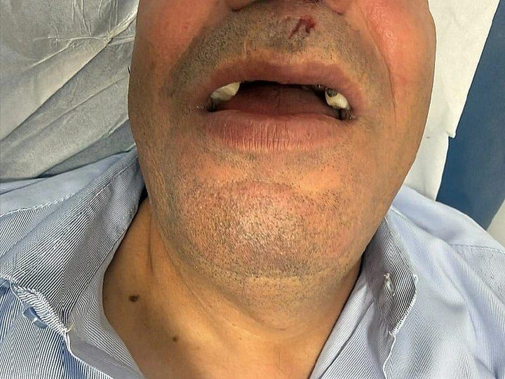 الاعتداء العنصري على سائق حافلة عربي في القدس يؤدي إلى كسر أنفه